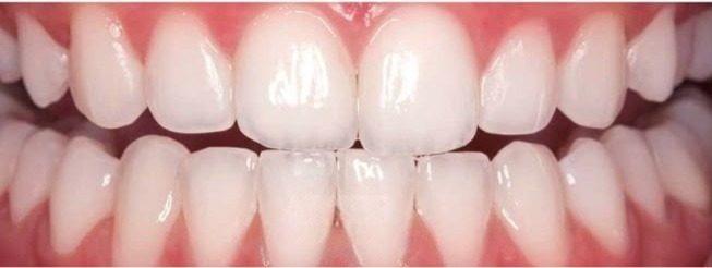 After Teeth Whitening Smile Transformation