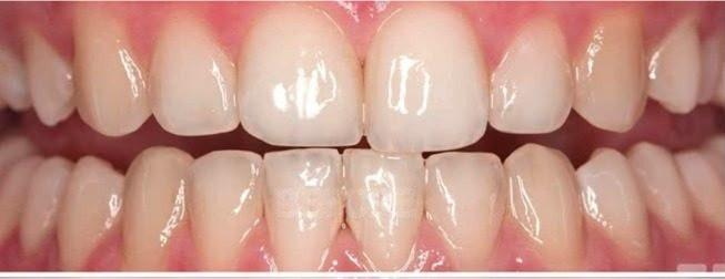 Before Teeth Treatment