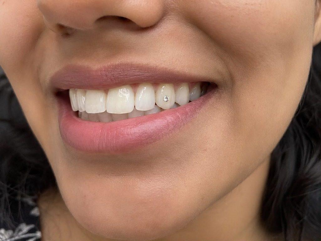 Canine Tooth Gem Diamond Crystal - Best Dentist in Rourkela ( Raurkela )