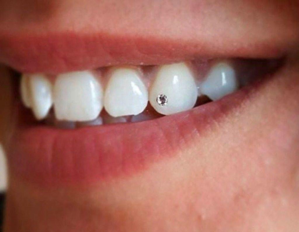 Single Crystal Tooth Gem Placement in Rourkela ( Raurkela ) - First Choice Dental