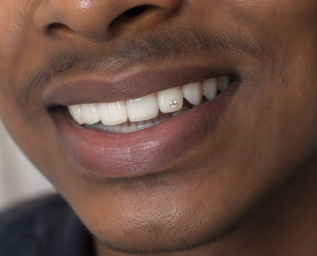 Tooth Gem Cosmetic Dentistry in Rourkela ( Raurkela ) - First Choice Dental