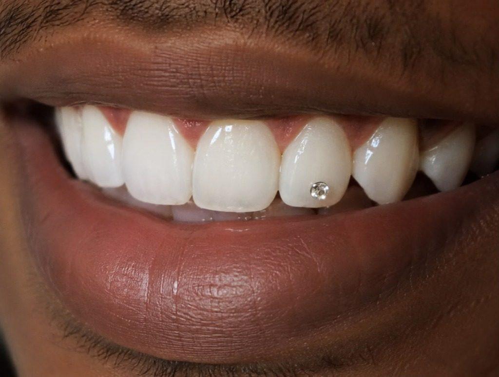 Tooth Gem Crystal Stud - Cosmetic Dentist in Rourkela ( Raurkela )