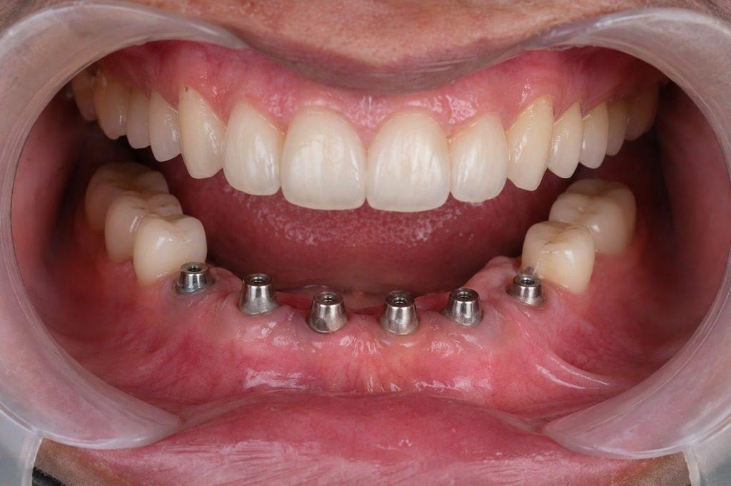 Dental Implants in Rourkela ( Raurkela ) - Titanium Abutments Placement