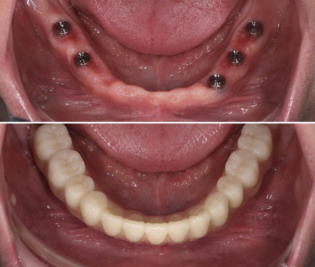 Dental Implants in Rourkela ( Raurkela ) - Full Mouth Dental Implant Rehabilitation