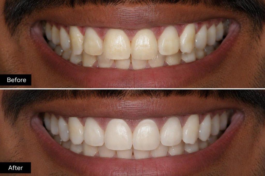 Teeth Whitening in Rourkela ( Raurkela ) - Laser Teeth Bleaching Before After Result