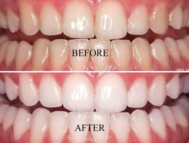 Teeth Whitening in Rourkela ( Raurkela ) - Enamel Bleaching Before After Result
