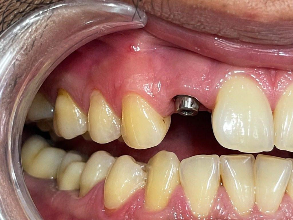 Single Tooth Zirconia Crown Implant