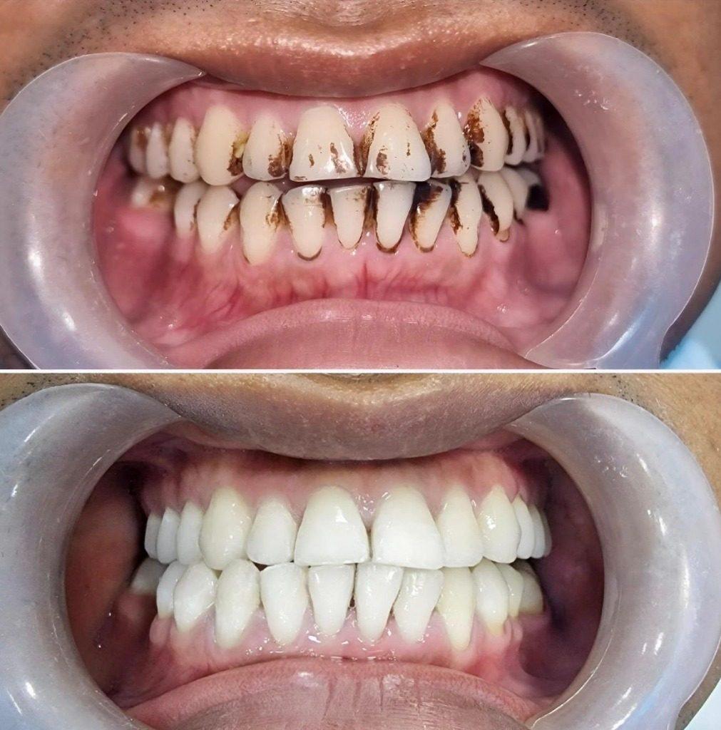 Clinical Teeth Whitening Stain Removal Case